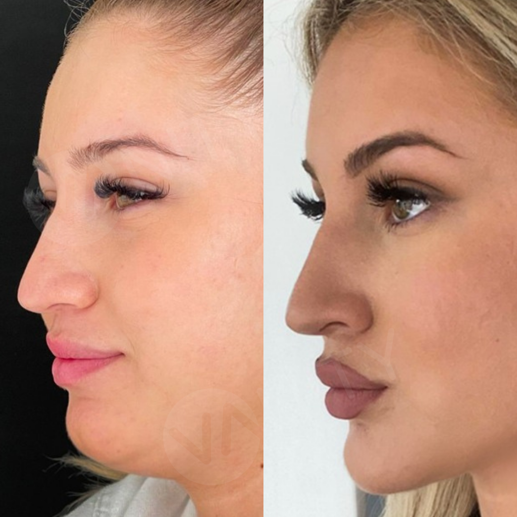 chin_lipo_ba_1