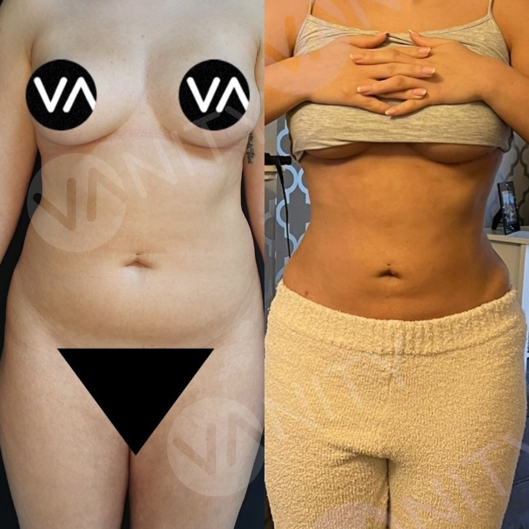 liposuction_ba_2