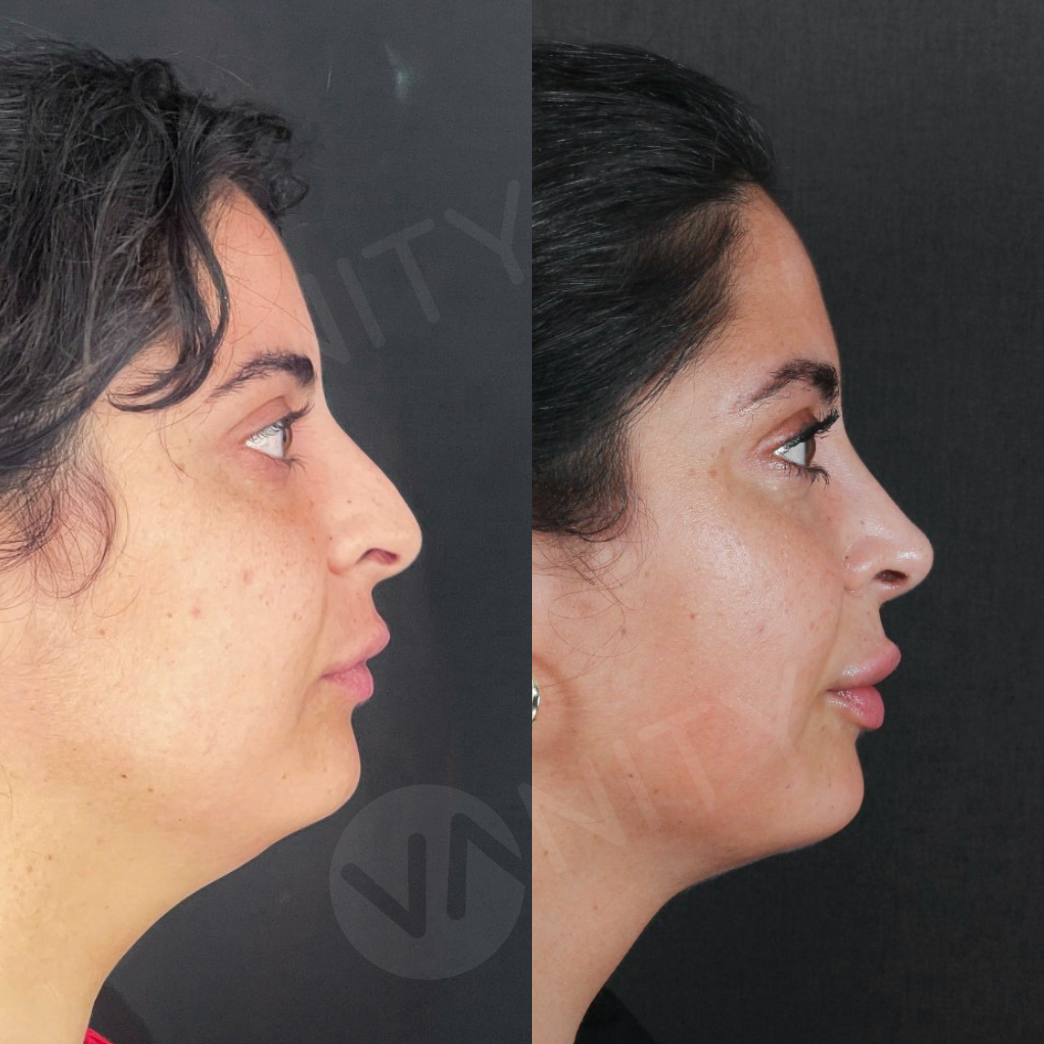 chin_lipo_ba_2