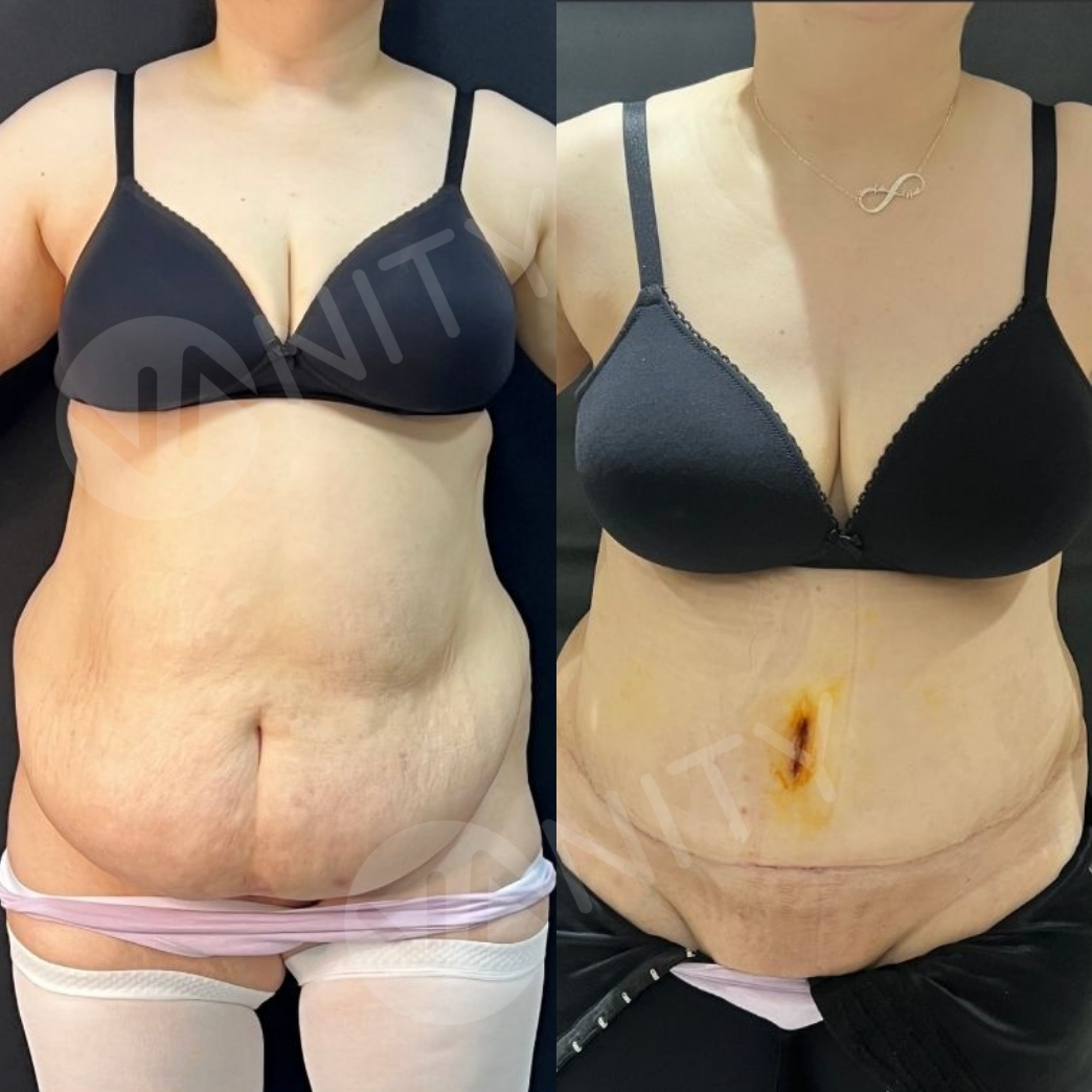 liposuction_ba_4