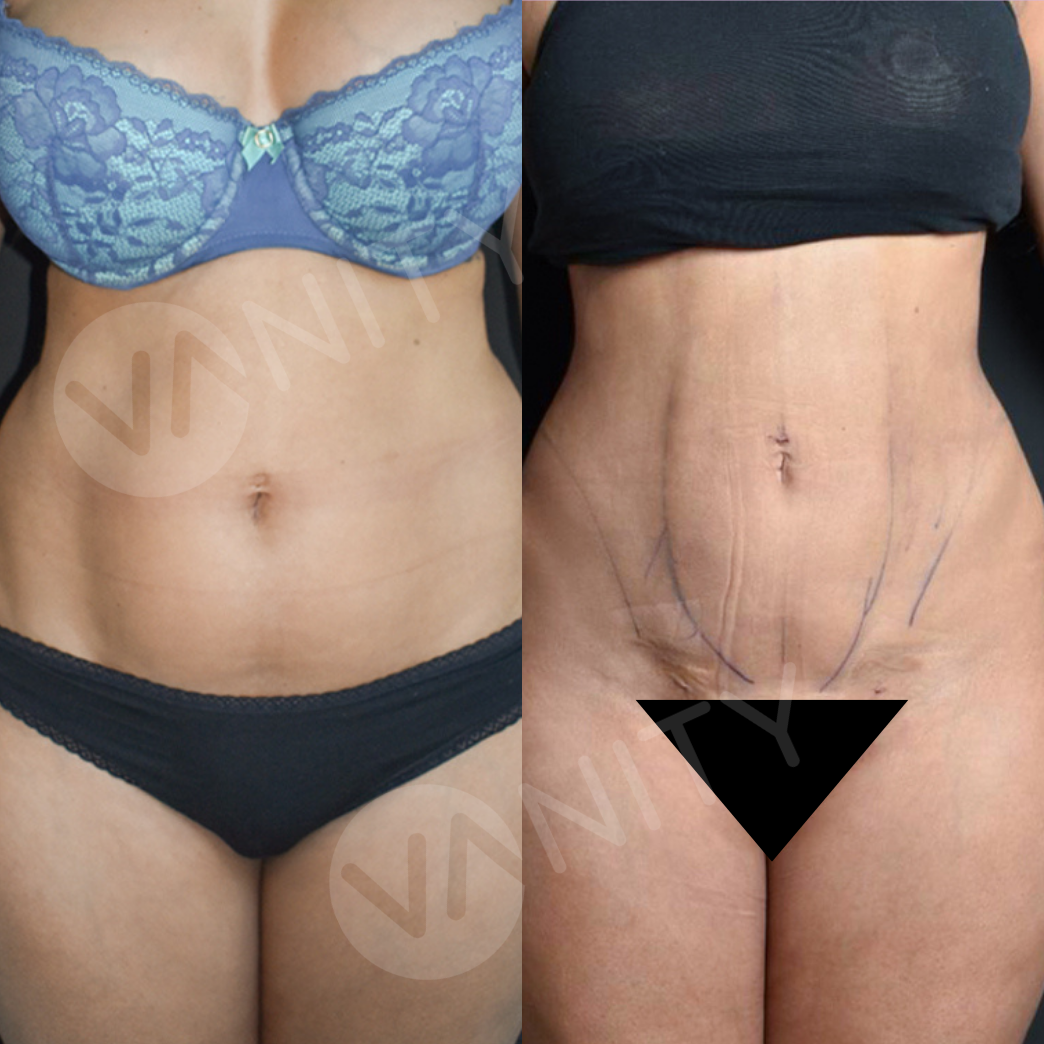 liposuction_ba_6